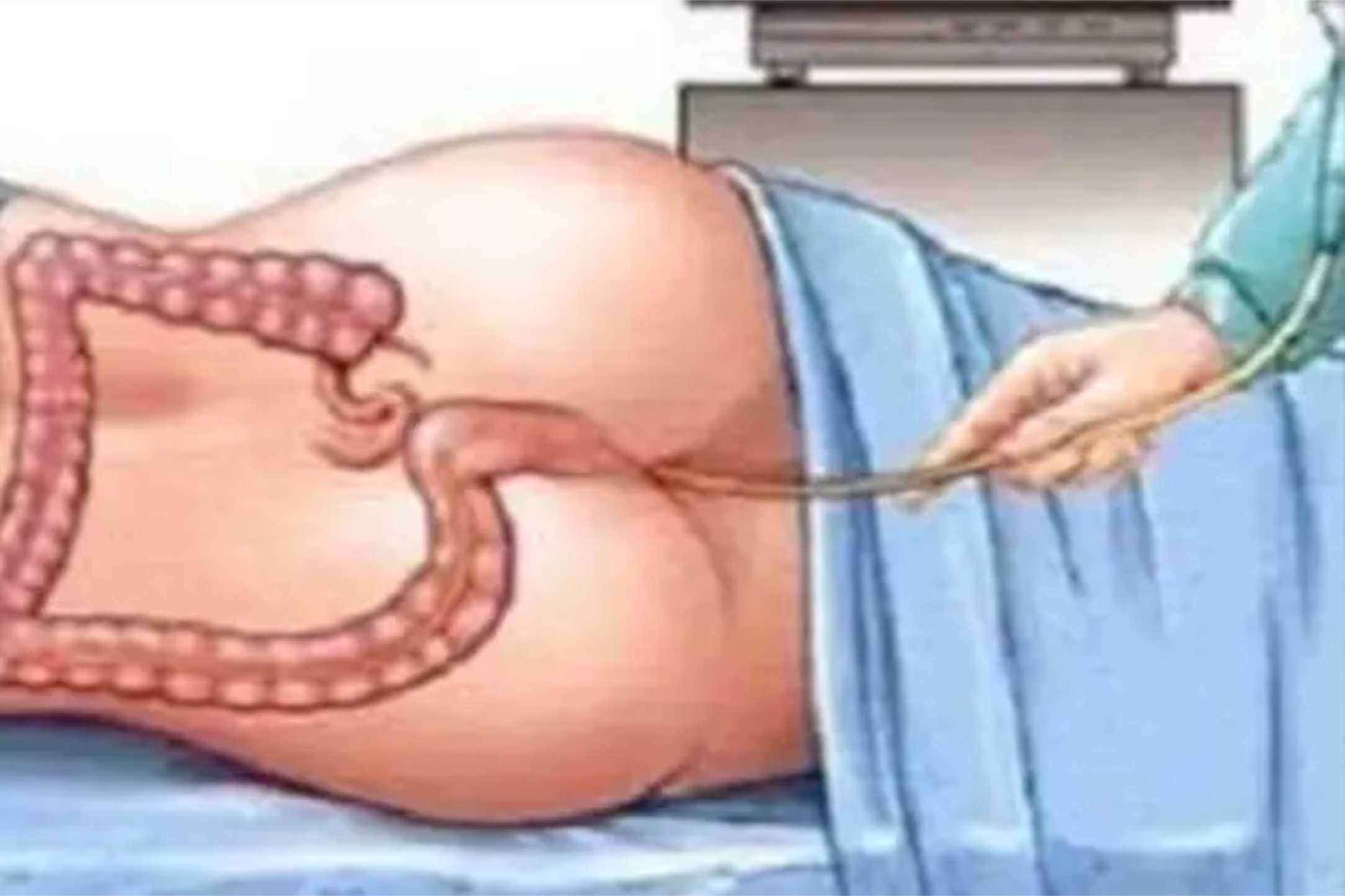 Sneha Vasti Treatment